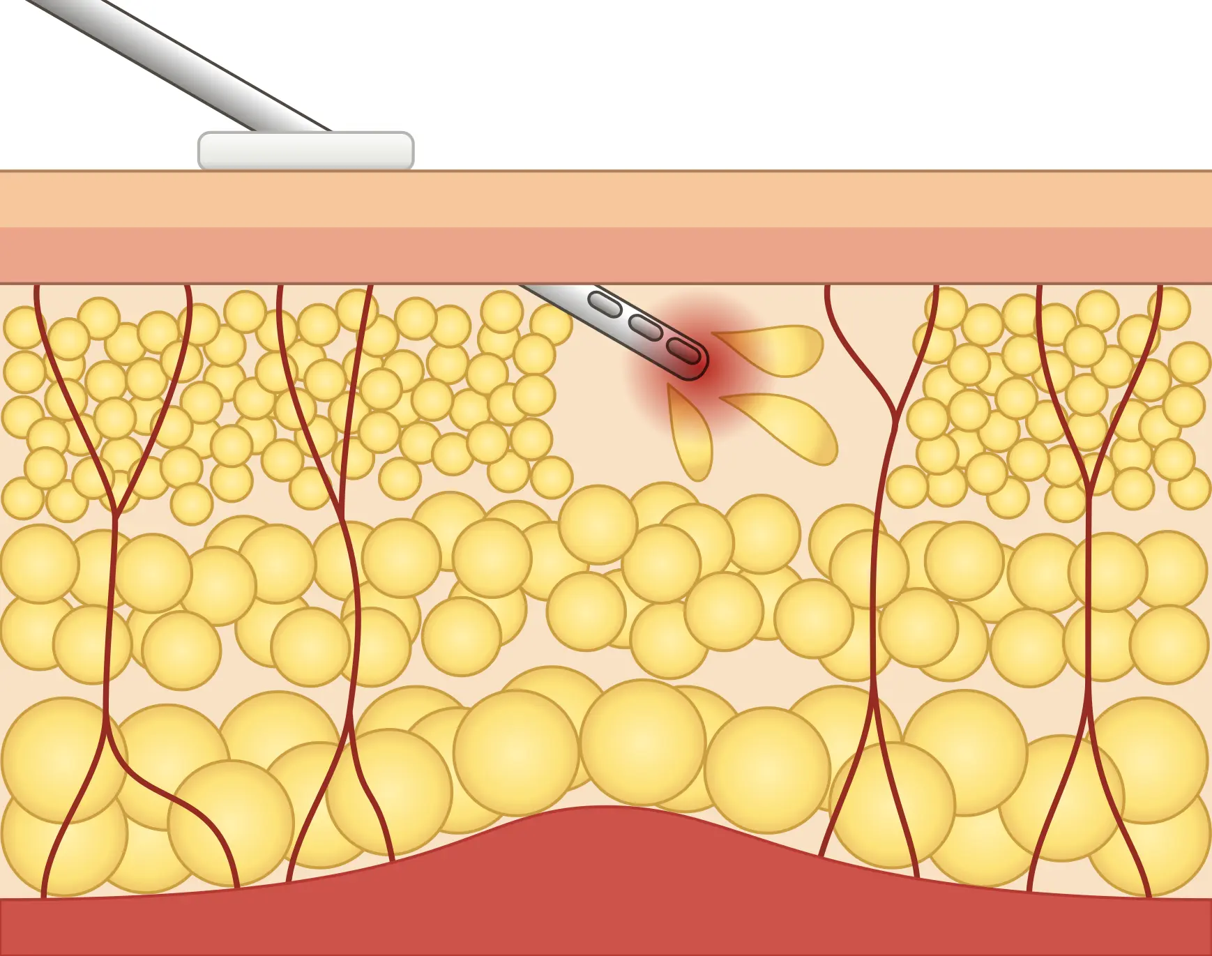 脂肪吸引の解説イラスト1