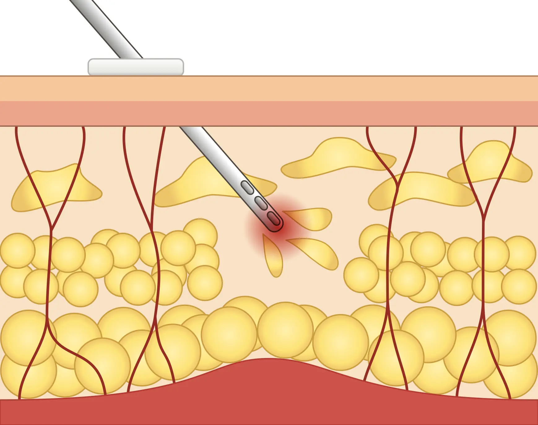 脂肪吸引の解説イラスト2