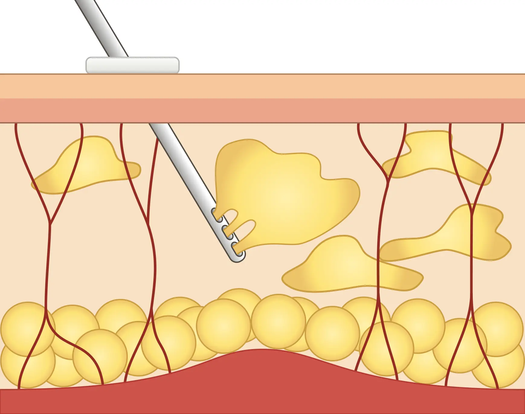 脂肪吸引の解説イラスト3