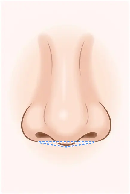 鼻柱下降術の解説イラスト3(AI生成)
