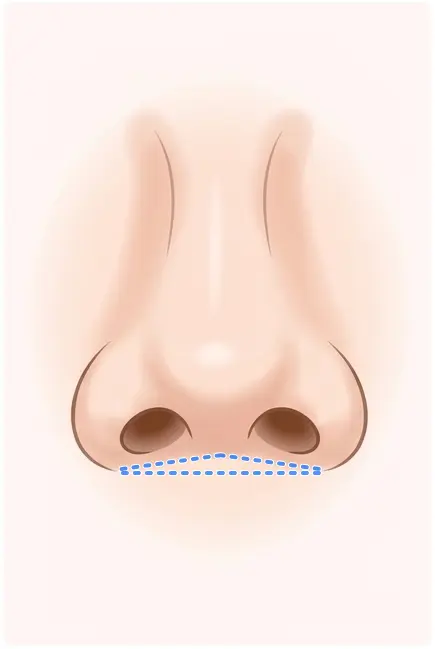 鼻柱下降術の解説イラスト2(AI生成)