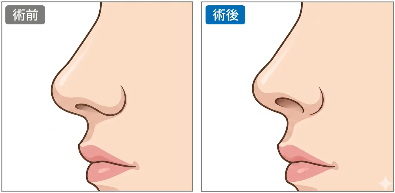 鼻翼鼻孔縁挙上の解説イラスト1(AI生成)