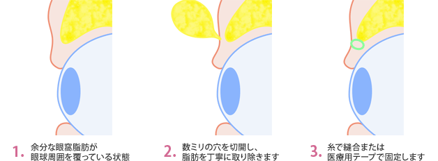 1.余分な眼窩脂肪が眼球周囲を覆っている状態。2.数ミリの穴を切開し、脂肪を丁寧に取り除きます。3.糸で縫合または医療用テープで固定します。